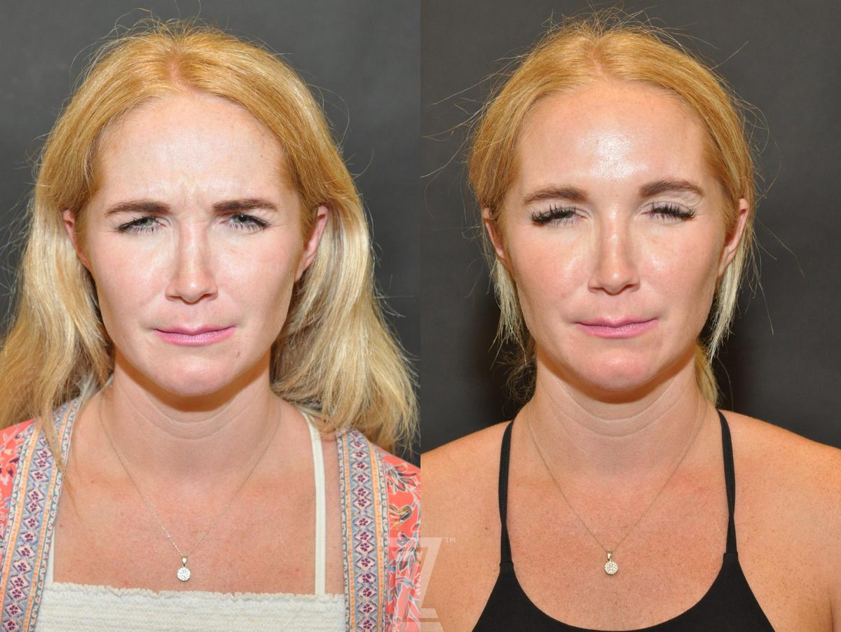 Before: BOTOX® Cosmetic — Case 575, The Piazza Center Austin