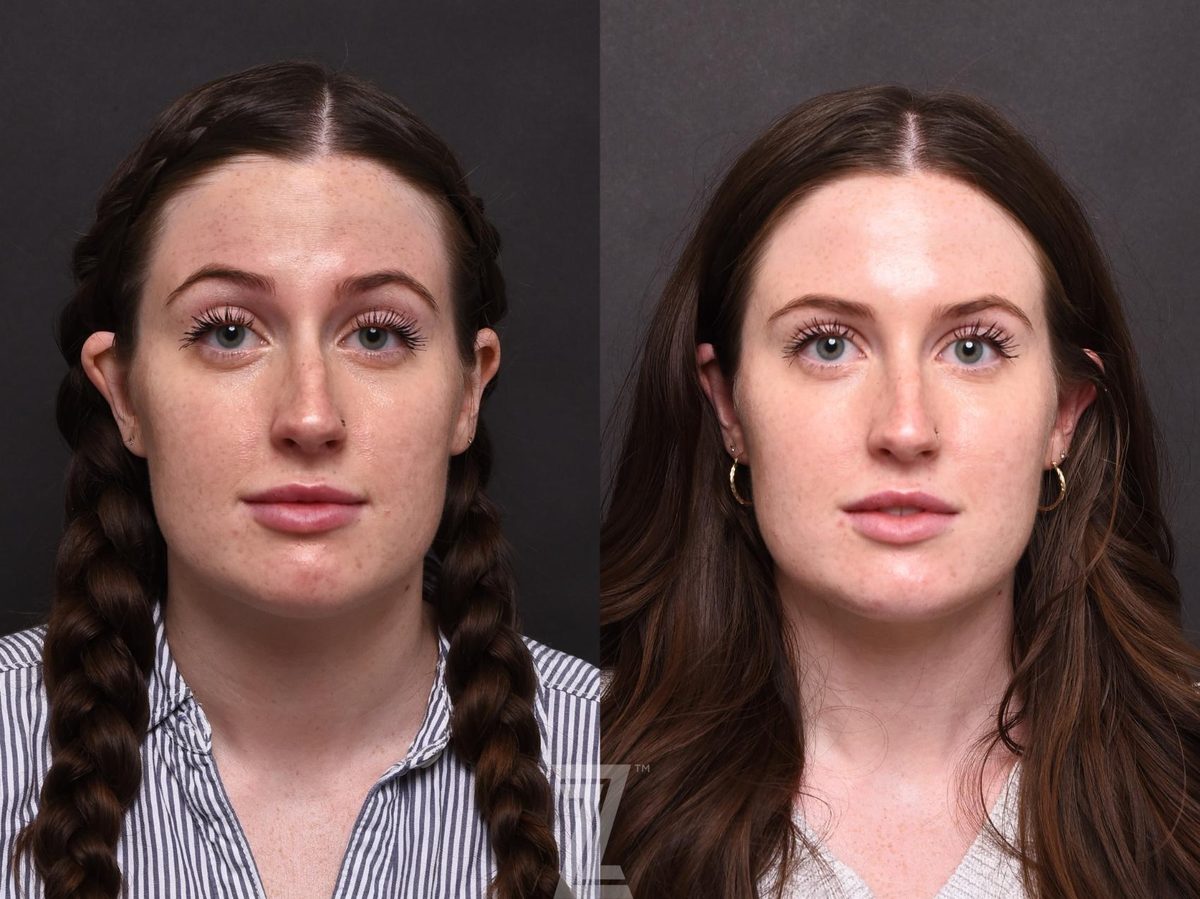 After: Wrinkles, BOTOX® Cosmetic — Case 499, The Piazza Center Austin