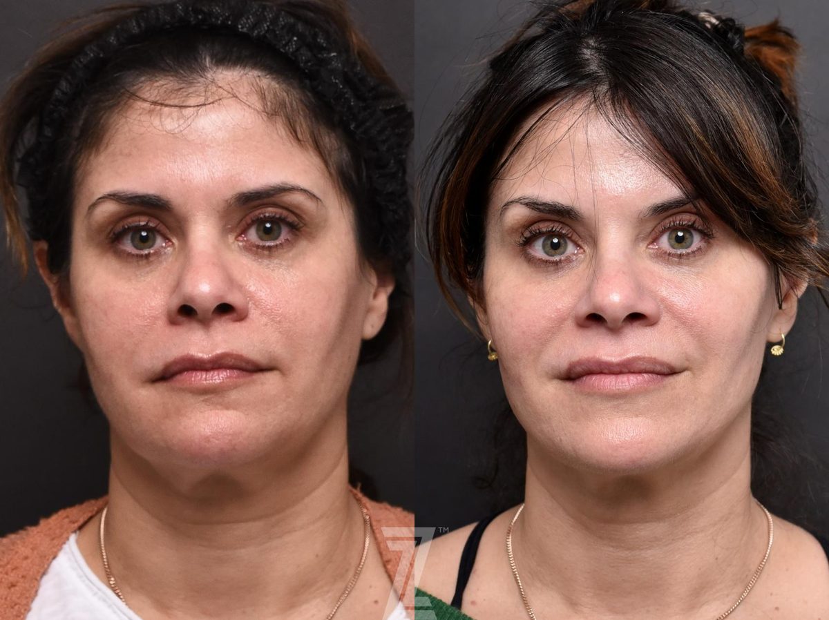 Before: BOTOX® Cosmetic, Injectable Fillers, Sculptra®, Injectable Fillers — Case 554, The Piazza Center Austin