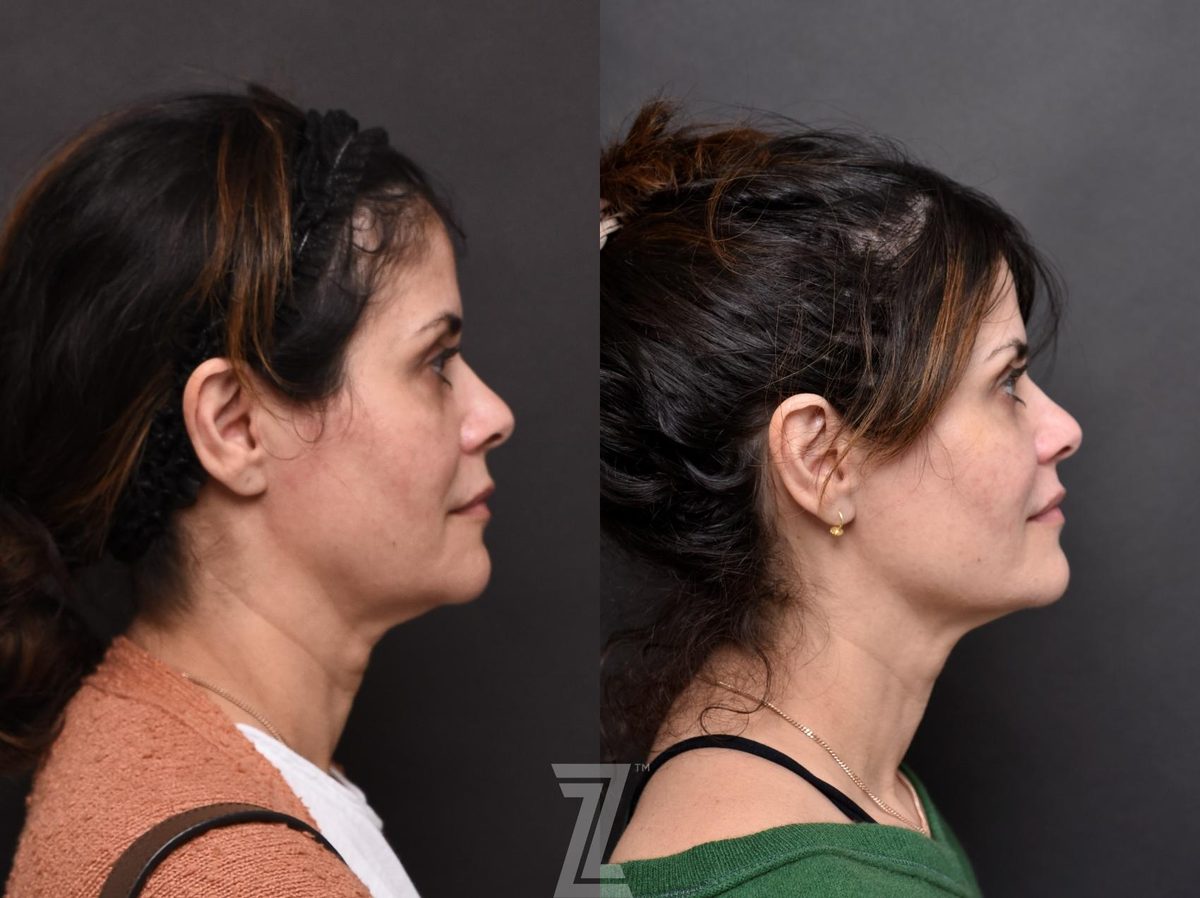After: BOTOX® Cosmetic, Injectable Fillers, Sculptra®, Injectable Fillers — Case 554, The Piazza Center Austin