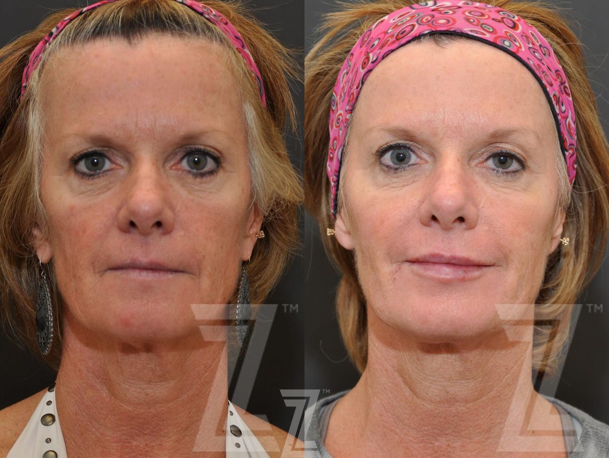 Before: Injectable Fillers — Case 262, The Piazza Center Austin
