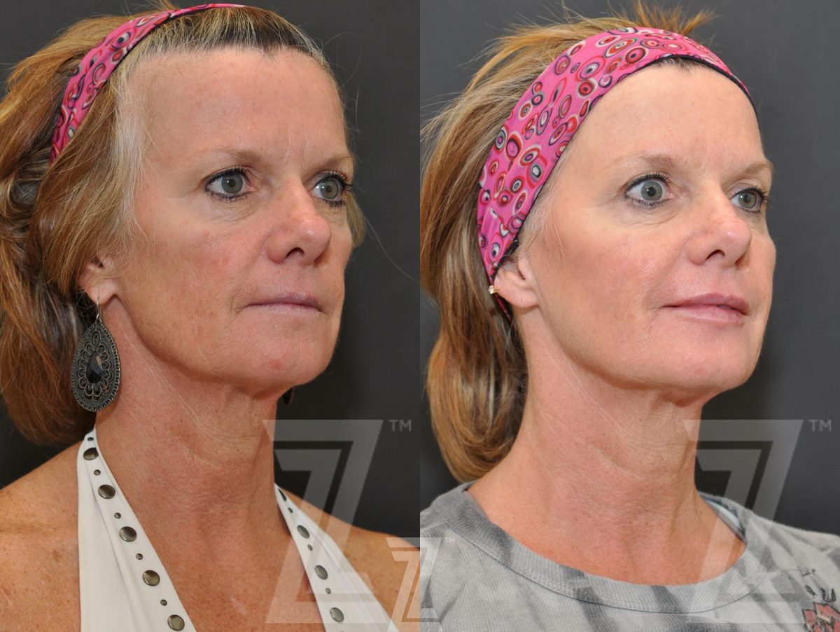 After: Injectable Fillers — Case 262, The Piazza Center Austin