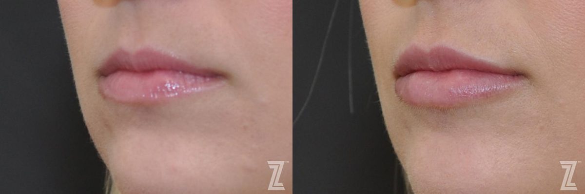 After: Injectable Fillers — Case 280, The Piazza Center Austin