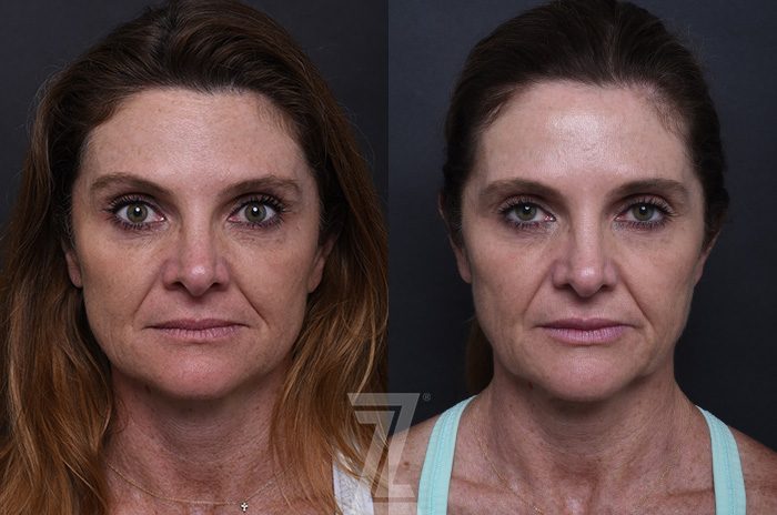Before: ezGEL PRF — patient case, The Piazza Center Austin