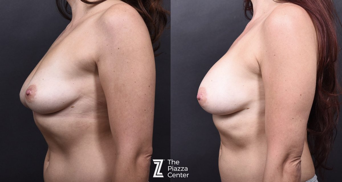 After: Breast Augmentation, Motiva Preserve — patient case, The Piazza Center Austin