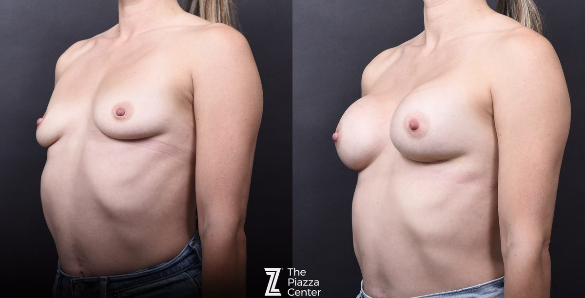 After: Breast Augmentation, Motiva, BTP (Breast Tissue Preservation) — patient case, The Piazza Center Austin