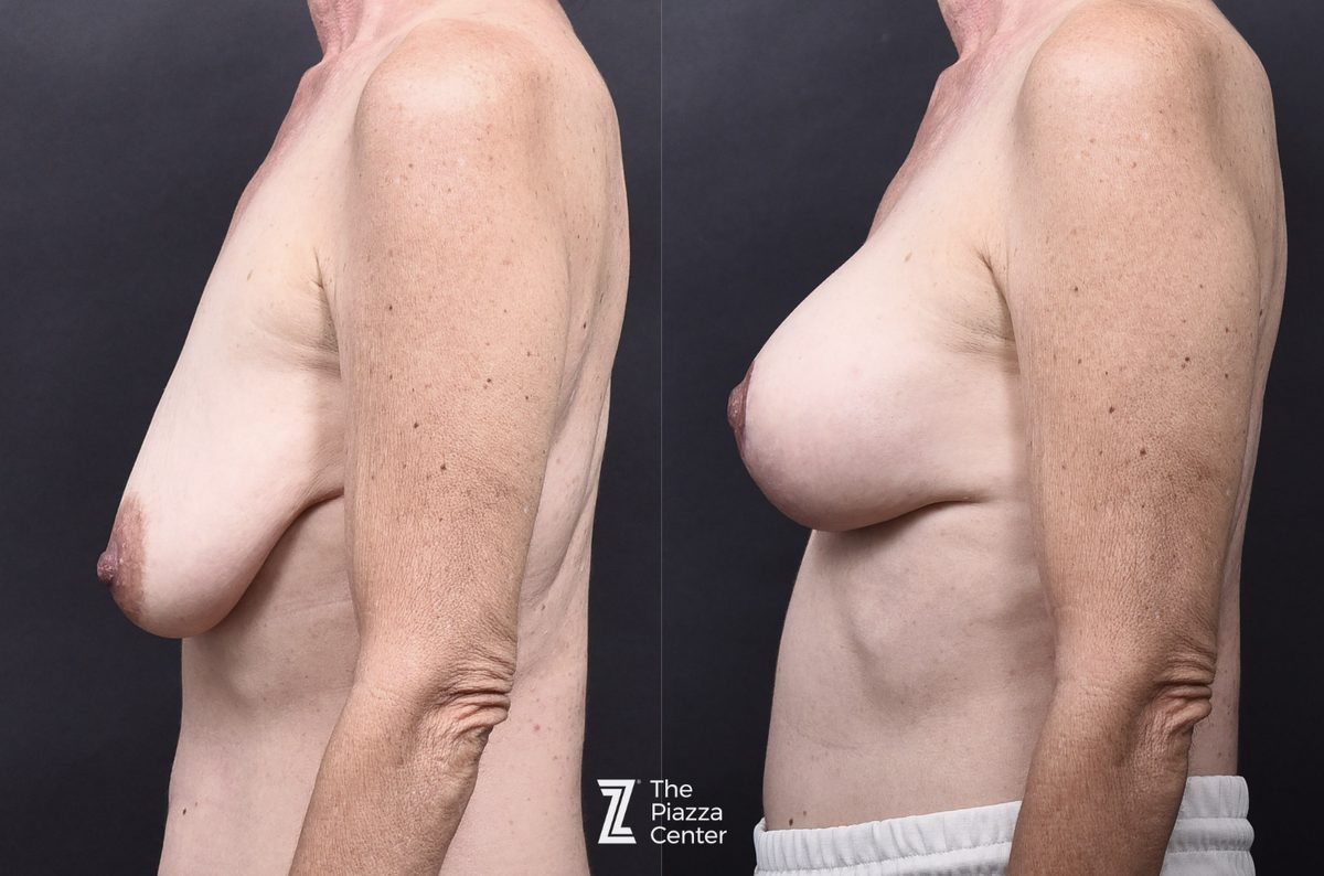 After: Breast Augmentation, Motiva, BTP (Breast Tissue Preservation) — patient case, The Piazza Center Austin