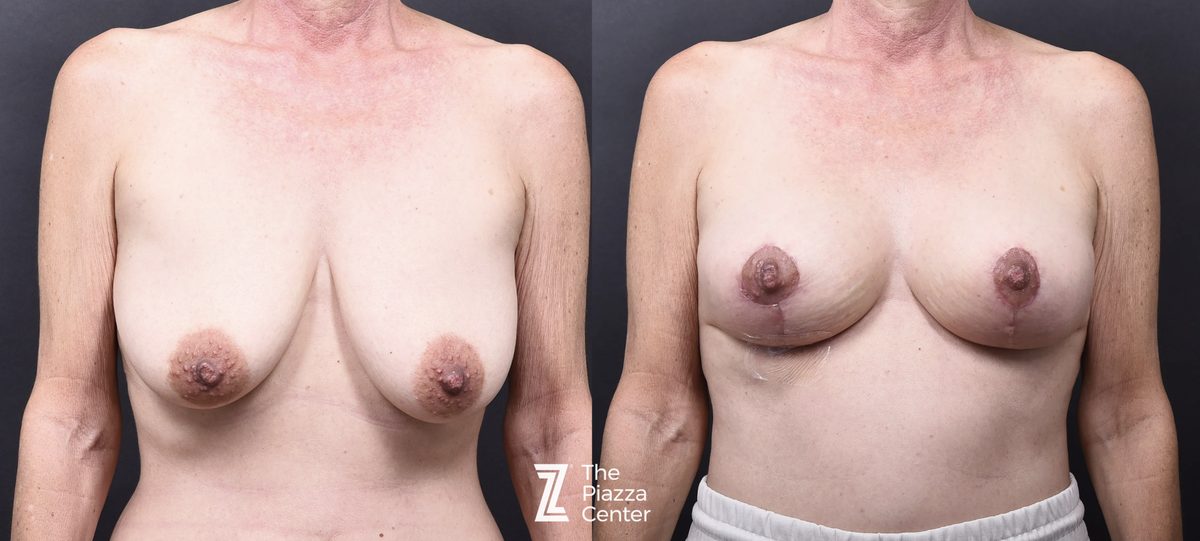 Before: Breast Augmentation, Motiva, BTP (Breast Tissue Preservation) — patient case, The Piazza Center Austin