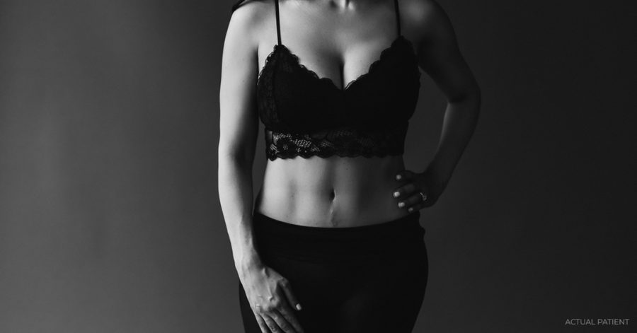 Diastasis Recti Repair with Tummy Tuck—An In-Depth Look | Austin, TX