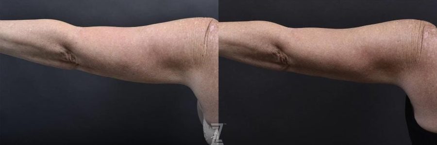 Profound microneedling for upper arms before and after tightens skin and reduces fat. 