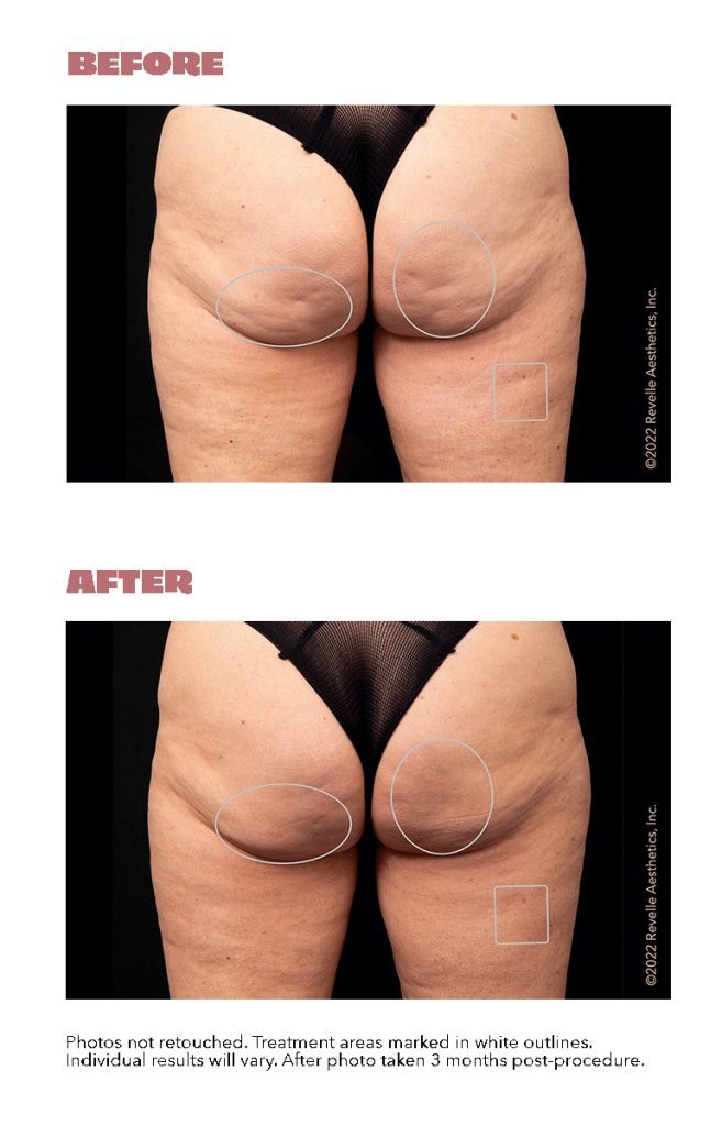 Can I treat cellulite & skin laxity of the buttock & thighs?