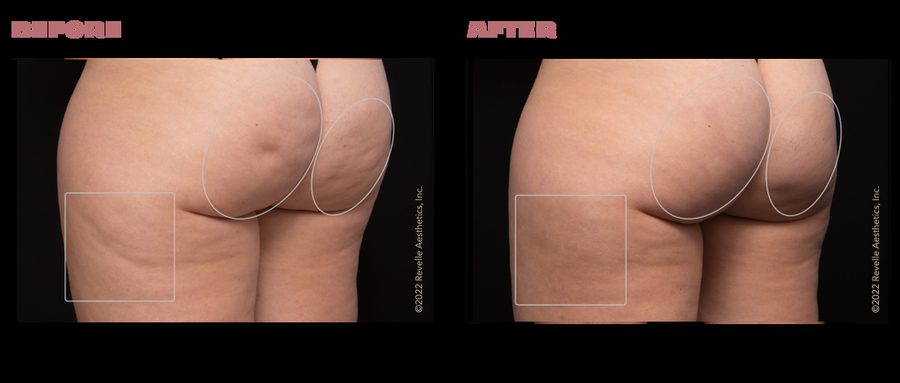 Aveli Cellulite Treatment Before and After aveli results
