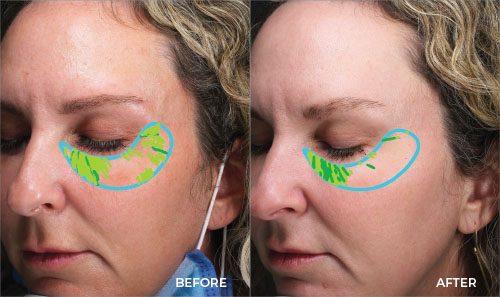 Why is the Visia Skin Analysis so Important? | Piazza Center for Plastic Surgery and Advanced Skin Care