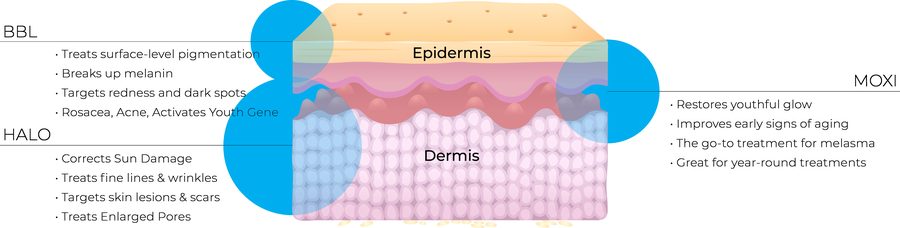 Sciton StaX infographic Infographic showing the layers of skin Moxi Halo BBL lasers
