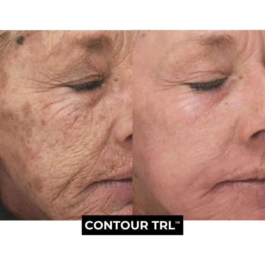 Contour TRL Treatment Austin Texas Contour TRL Treatment Before and After