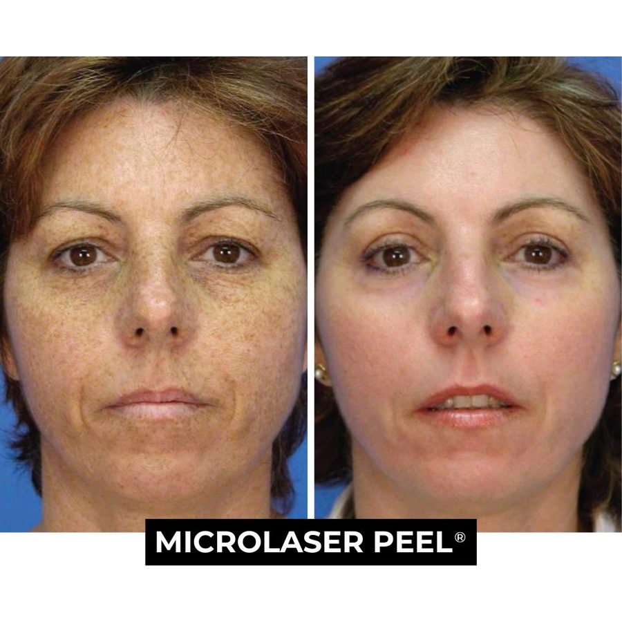 Micro Laser Peel Austin Results Before and After Micro Laser Peel Benefits