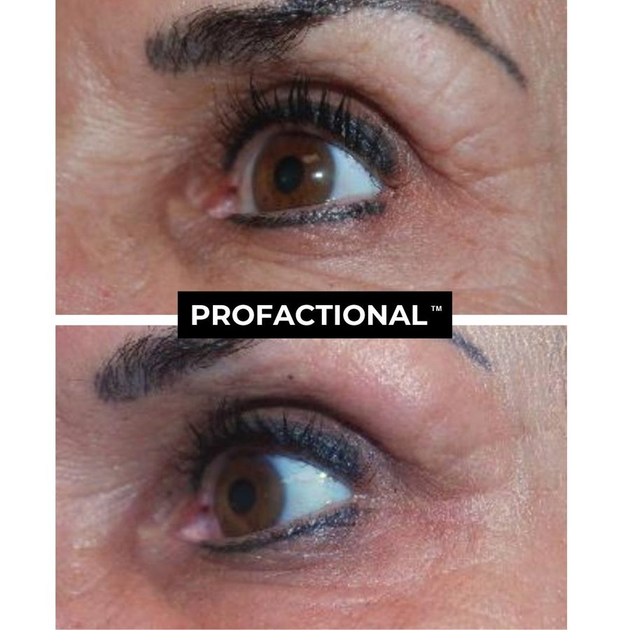 Profractional Laser Austin Profractional Laser Austin Before and After