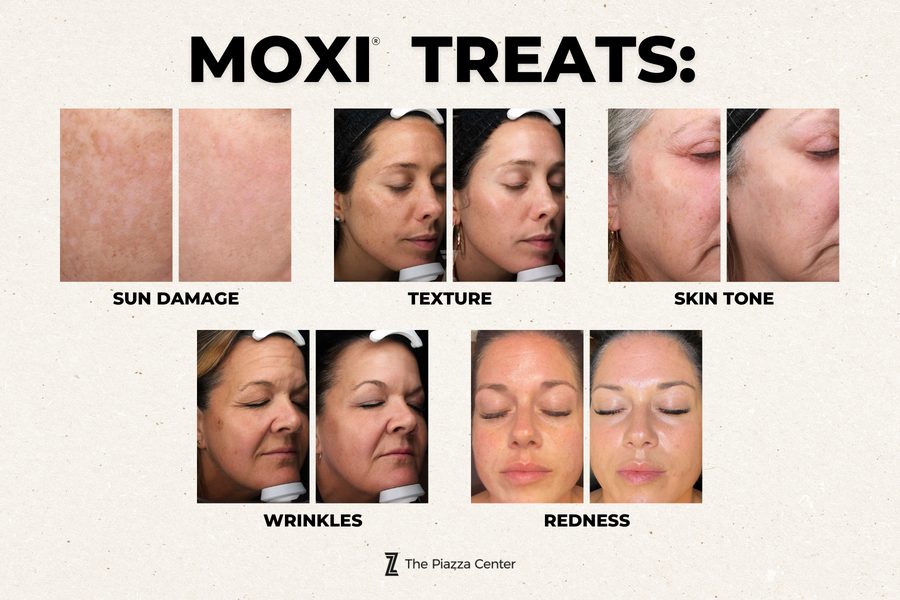 Moxi Laser in Summer - What it Treats What Moxi treats