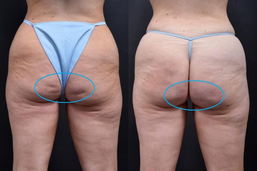 Aveli Treatment cellulite before and after Piazza Center Patient Aveli cellulite before and after
