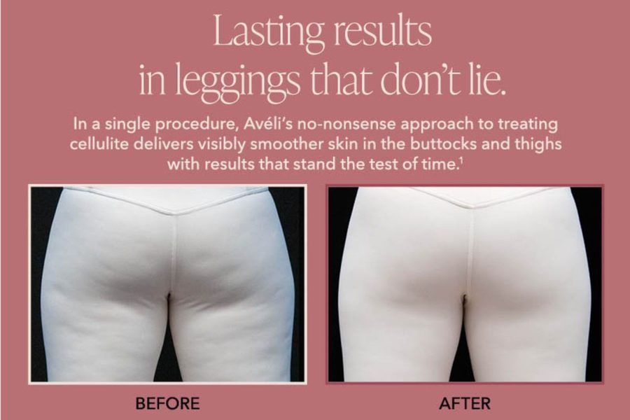 Aveli Cellulite Procedure in Austin TX Woman in leggings before and after aveli procedure for cellulite