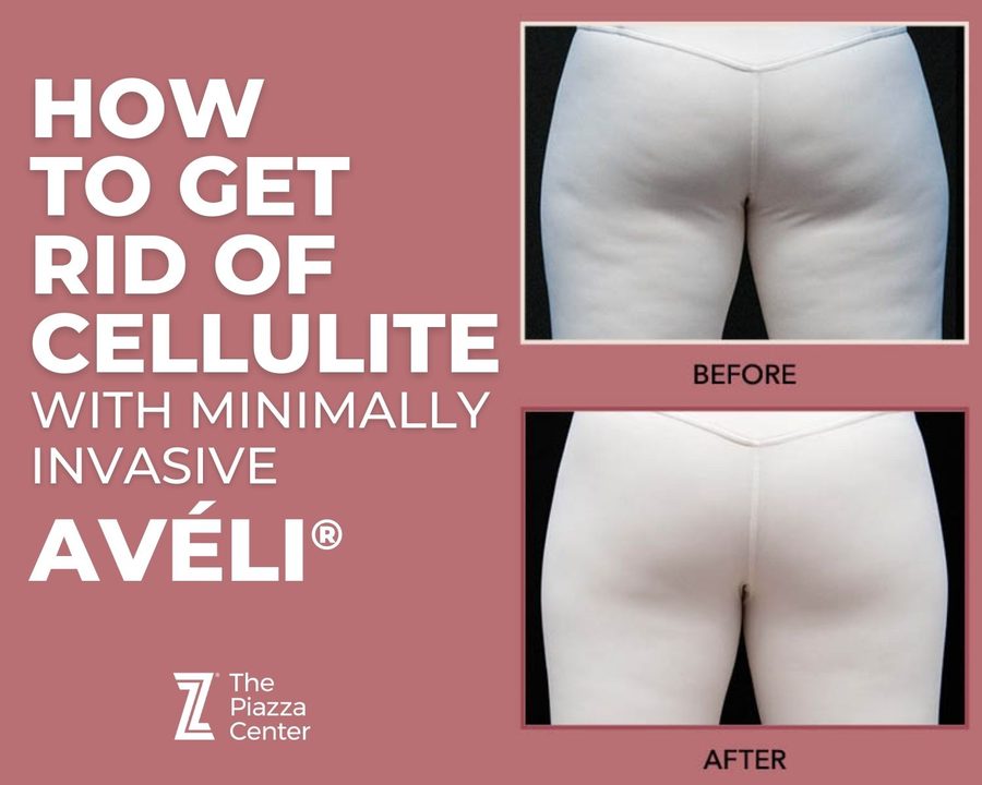 How to get rid of cellulite in 2024: Avéli®