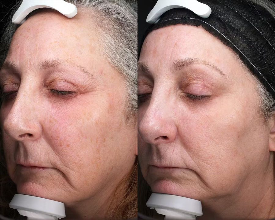 Sciton StaX Moxi Halo BBL Before and After Results Older woman before and after photos of Sciton StaX laser treatments