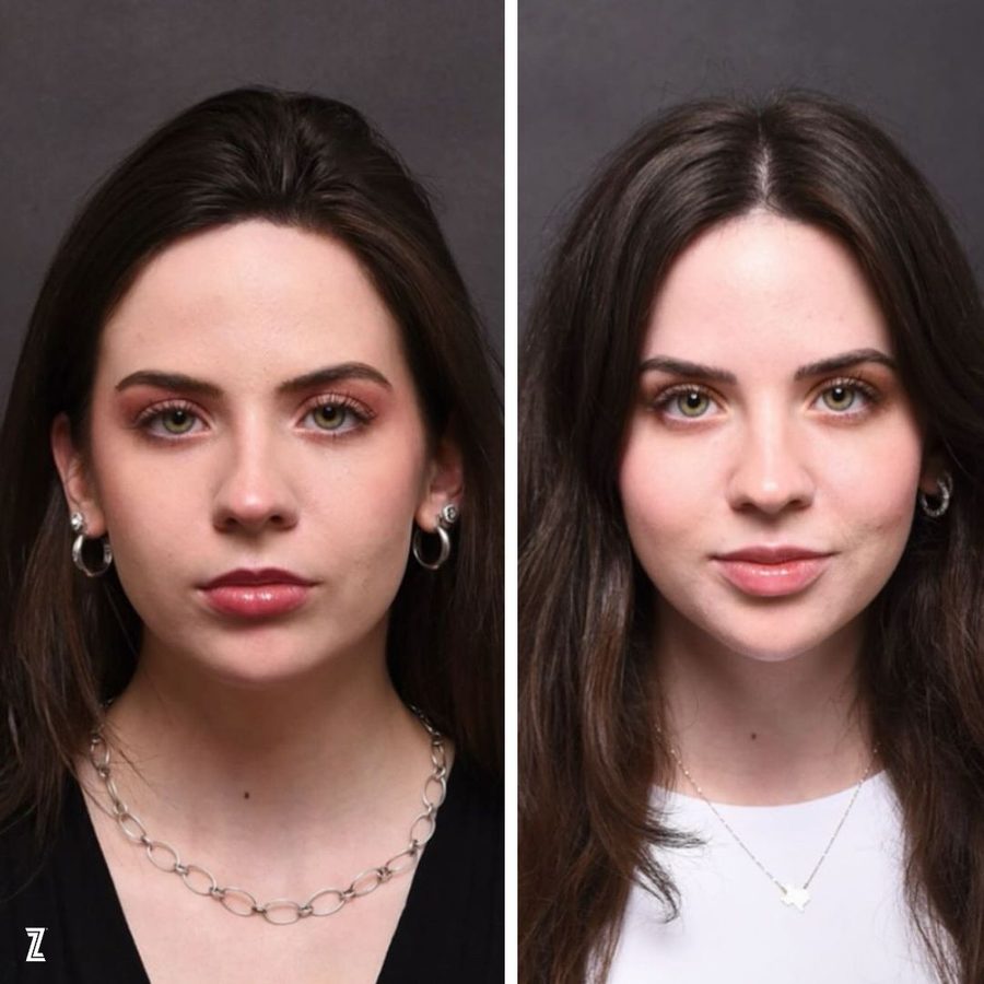 full facial balancing before and after full facial balancing before and after in Austin Texas
