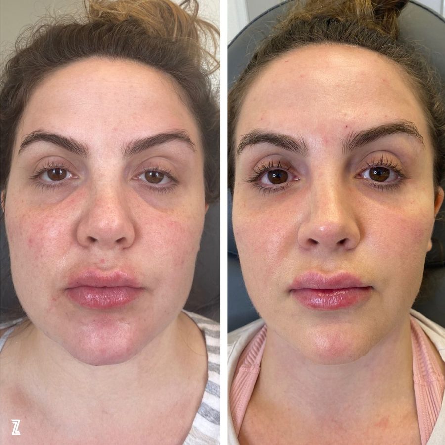 full face balancing before and after before and after full facial balancing results