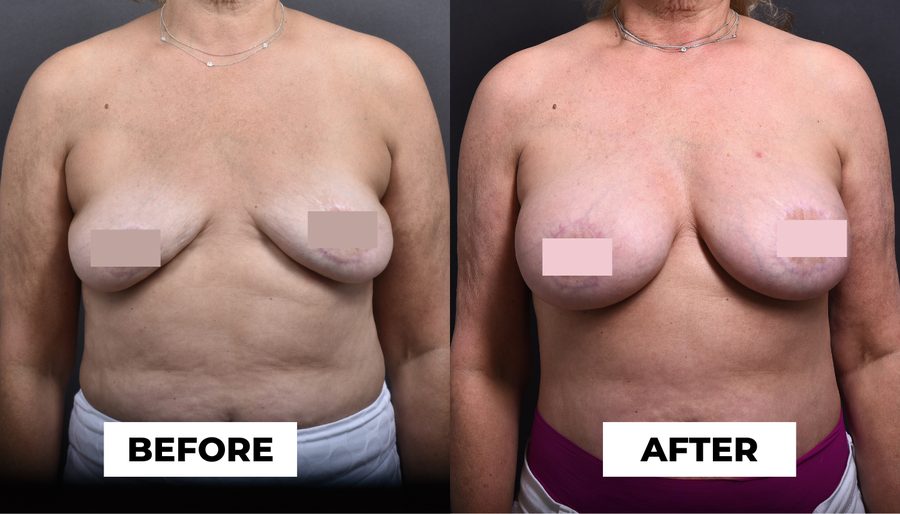Fat Transfer and Implant Breast Before and Afters Breasts Before and After Fat Transfer + Implants