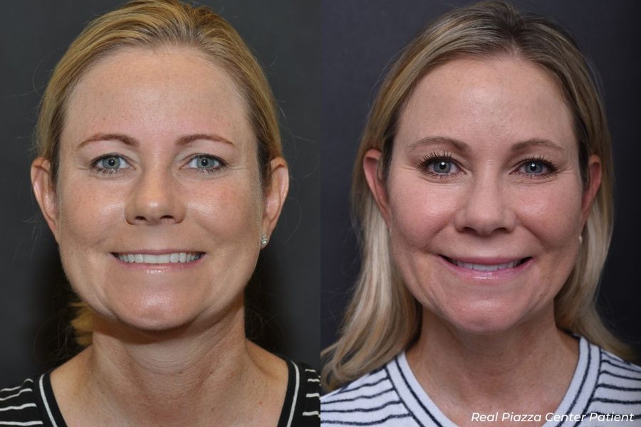 Facial Balancing Before and After 4 Full Face Balancing Before and After