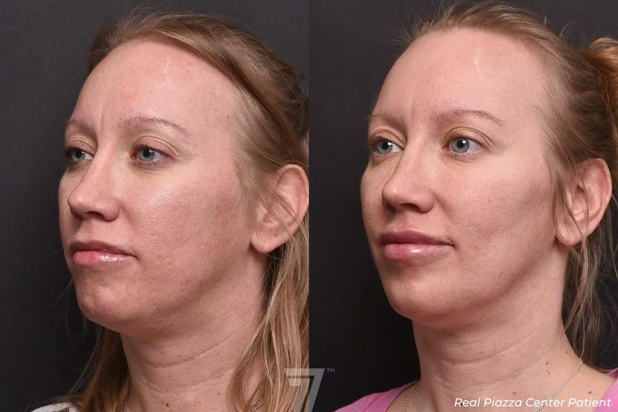 Facial Balancing Before and After 3 Full Face Rejuvenation Before and After