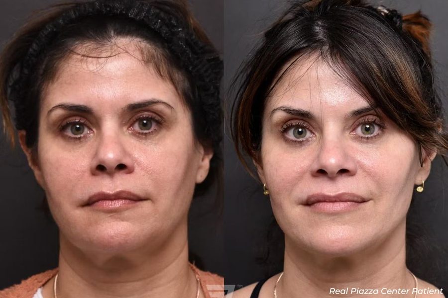 Facial Balancing Before and After Before and After Facial Balancing Austin TX