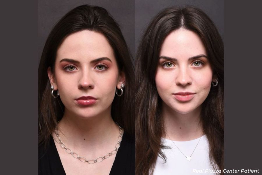 Facial Balancing Before and After Facial Balancing Piazza Center Before and After