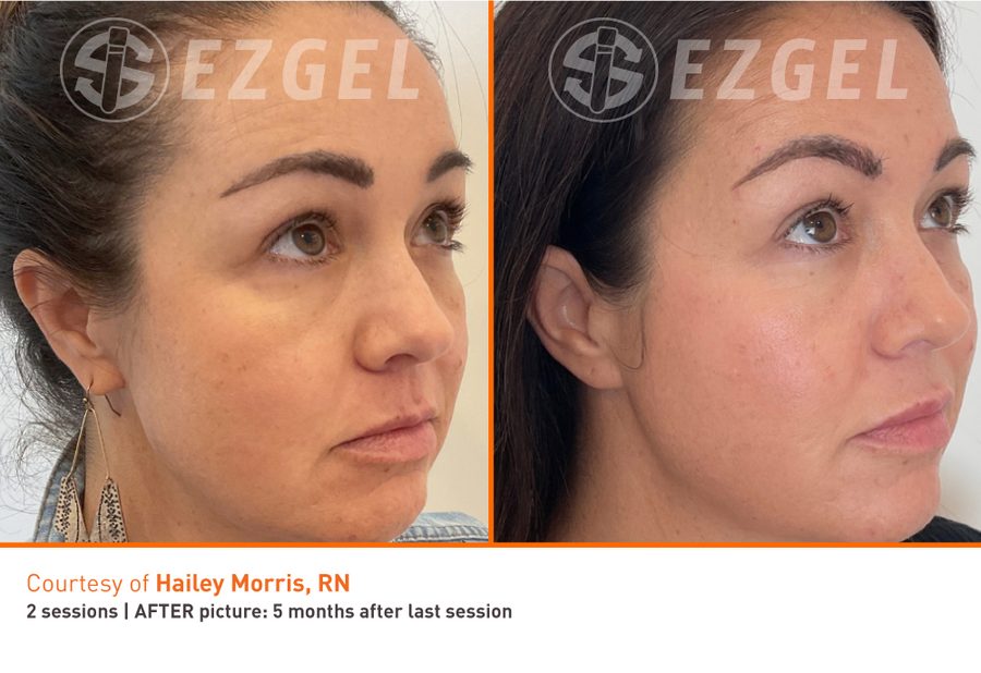 under eye results with ezGEL