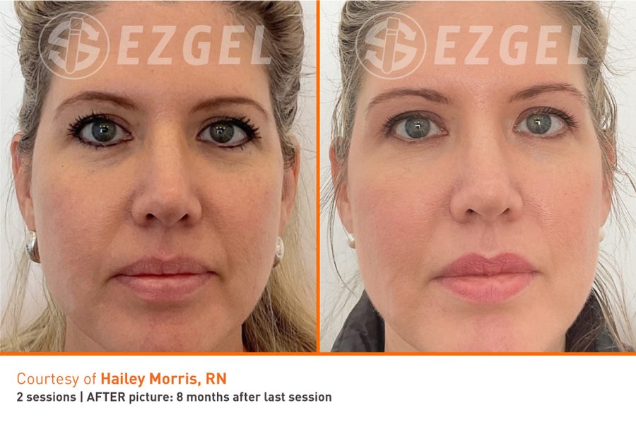 ezGEL Results