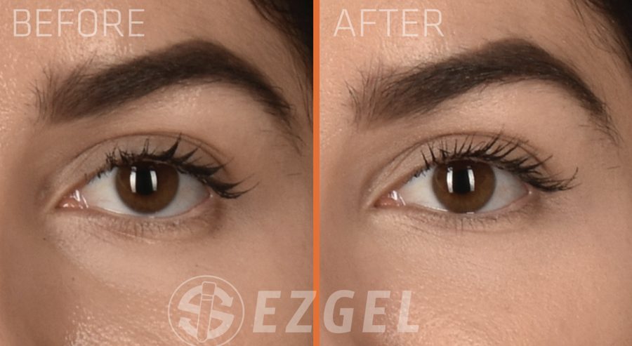 ezGEL vs Filler under eye results ezGEL results under the eye