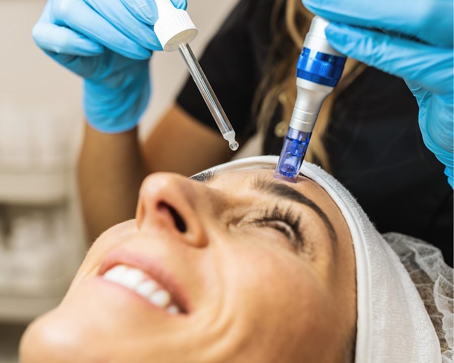 Microneedling with Exosomes Microneedling treatment with added exosomes