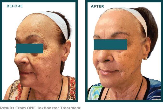 ToxBooster Before and After ToxBooster Treatment Results