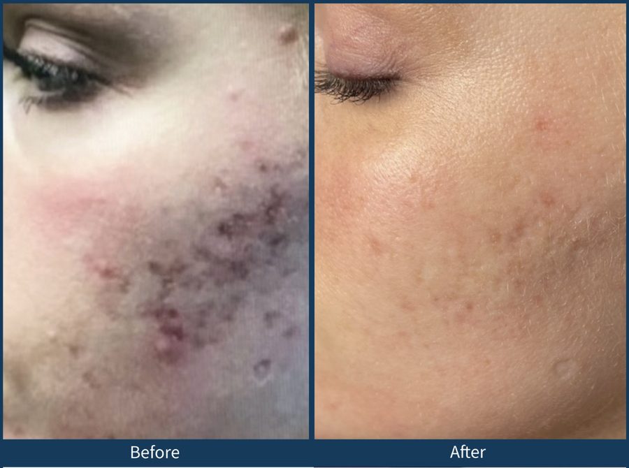 Microneedling in Austin