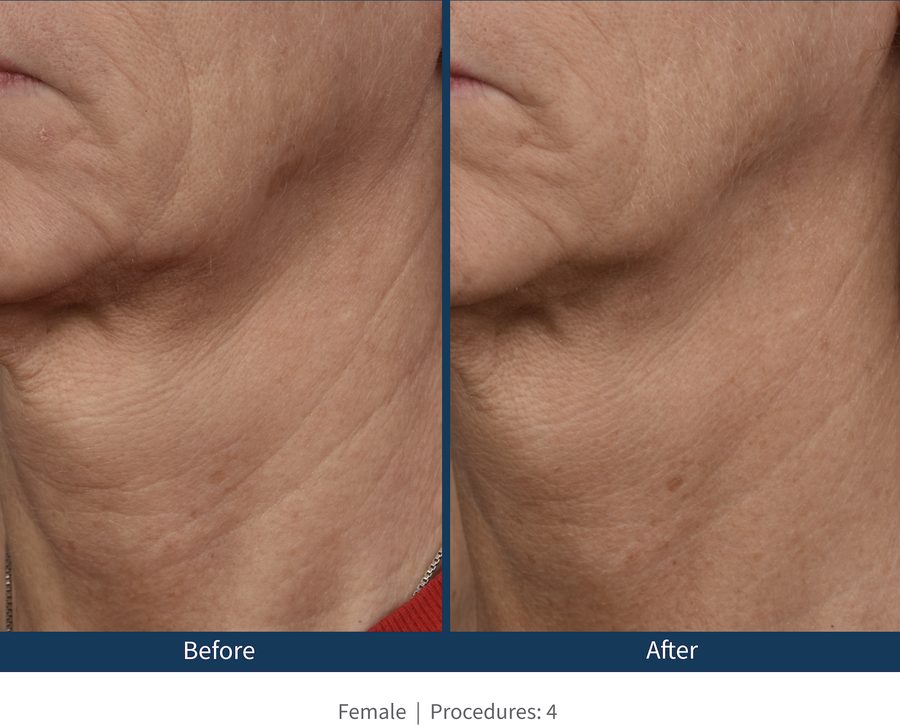 Microneedling Before and After Wrinkles Wrinkles before and after microneedling