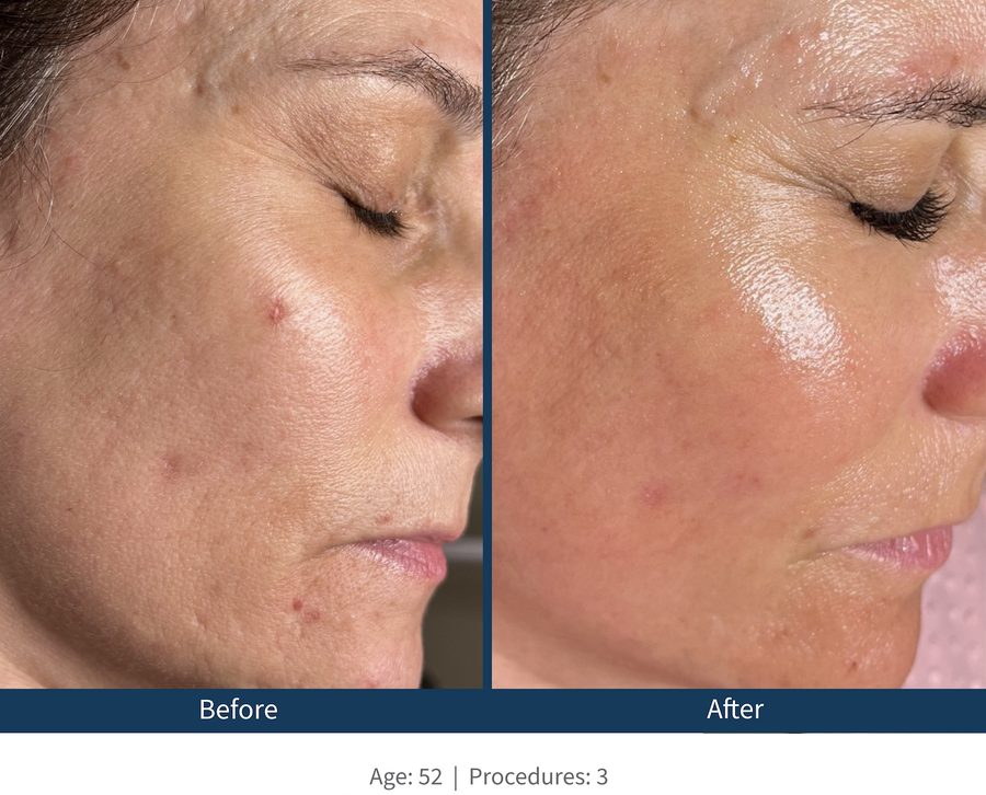 Microneedling Before and After texture Texture + Pore Size after Microneedling Austin TX