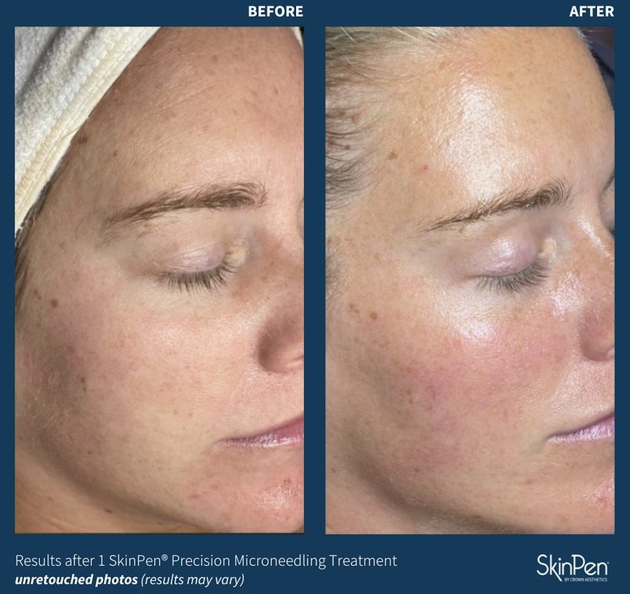 Microneedling in Austin
