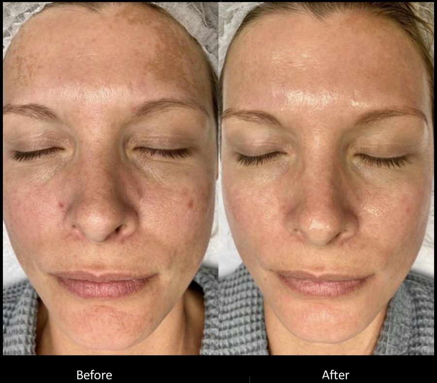 Melasma treatment before and after Melasma before and after moxi