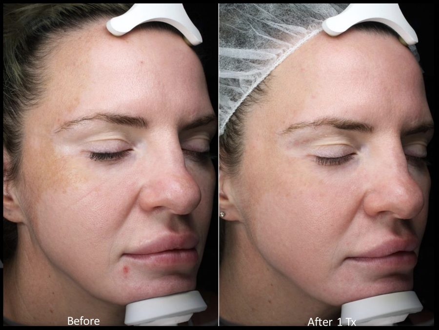 Melasma results from MOXI laser MOXI for Melasma