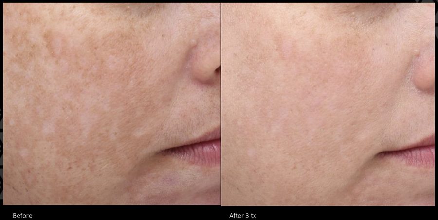 MOXI for Melasma before and after Melasma treatment with MOXI laser
