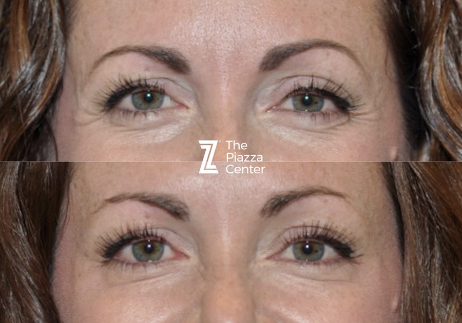 Crow's Feet Solution with Botox