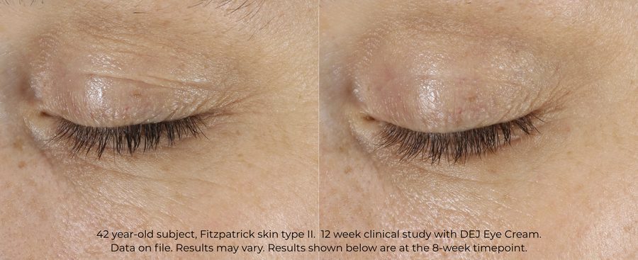 DEJ Eye Cream for Crows Feet Before and After DEJ Eye Cream