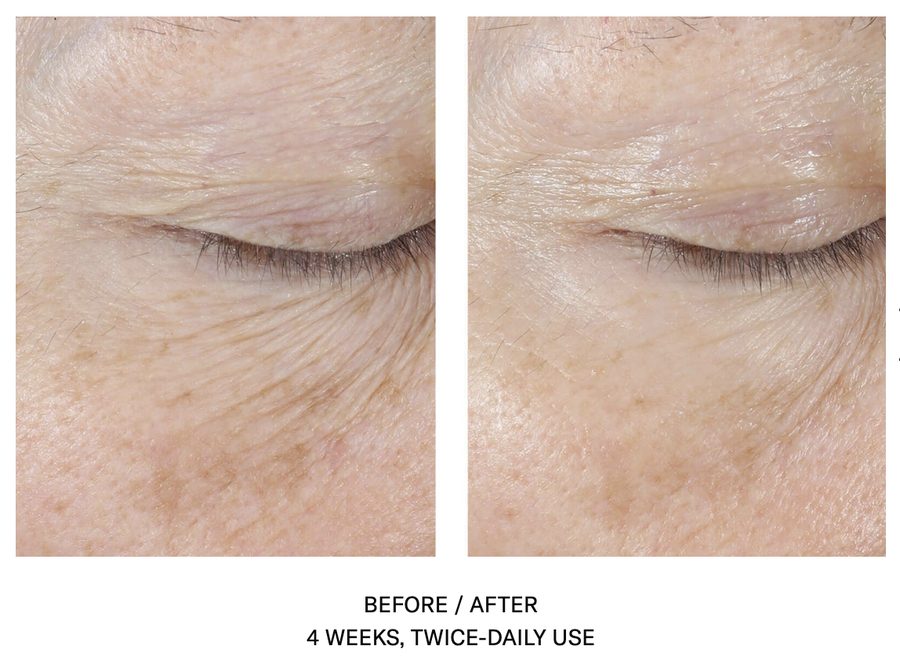 InterFuse Treatment Cream EYE for Crows Feet InterFuse Eye Cream Before and After