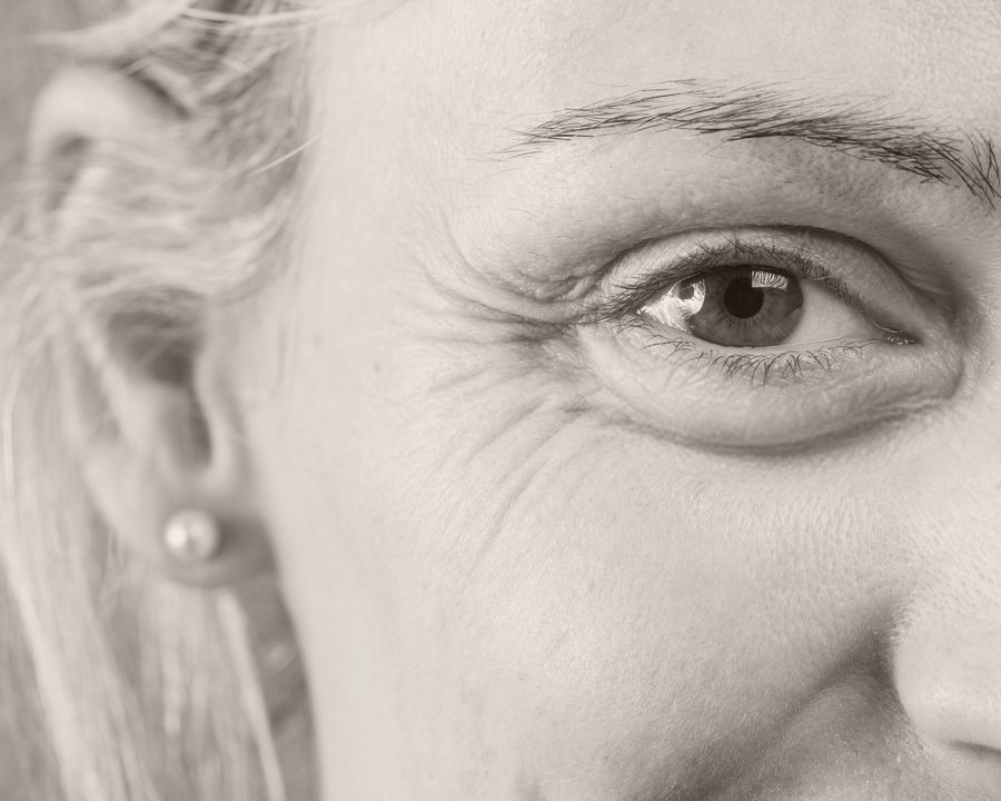How to Get rid of Crows Feet Eye wrinkles