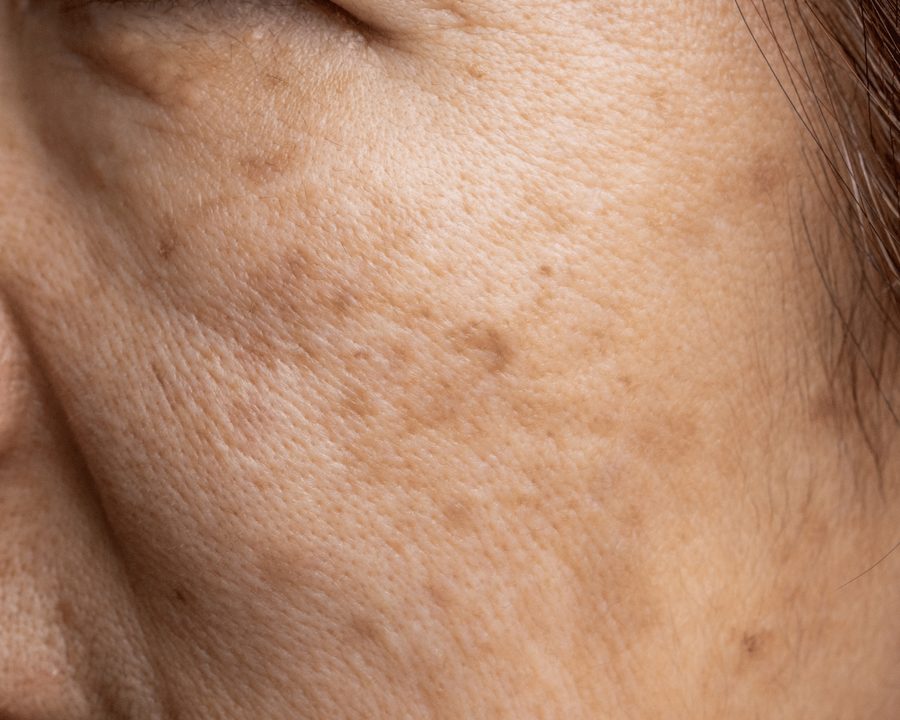 Melasma How to Treat it What is Melasma